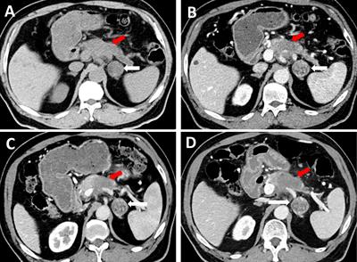 An Unexpected Case Report of Adrenal Lymphangioma: Mimicking Metastatic Tumor on Imaging in a Patient With Pancreatic Cancer